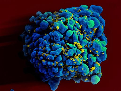 FILE - This April 12, 2011 electron microscope image made available by the National Institute of Allergy and Infectious Diseases shows an H9 T cell, blue, infected with the human immunodeficiency virus (HIV), yellow. (AP Photo/NIAID)