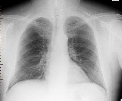 normal chest x-ray