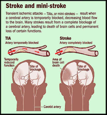 stroke-ministroke