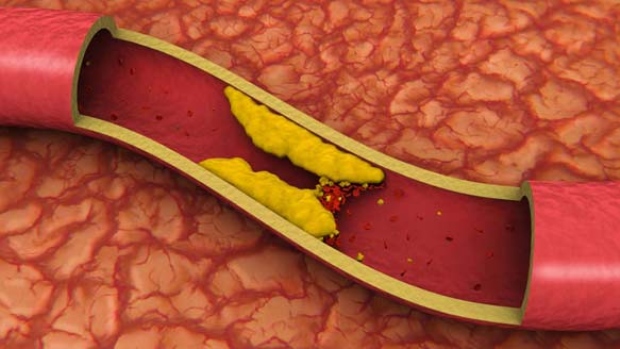 High cholesterol levels can lead to a build-up of plaque in the arteries, which can increase your risk of heart attack and stroke. (iStock photo)
