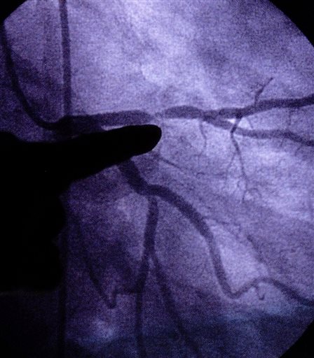 In this Monday, June 24, 2002 file photo, a doctor points to an image of a coronary artery with 80-90 percent blockage in St. Louis. A study published by the New England Journal of Medicine on Wednesday, April 8, 2015 finds genes that govern height also seem to affect cholesterol, especially in men. (AP Photo/Tom Gannam)