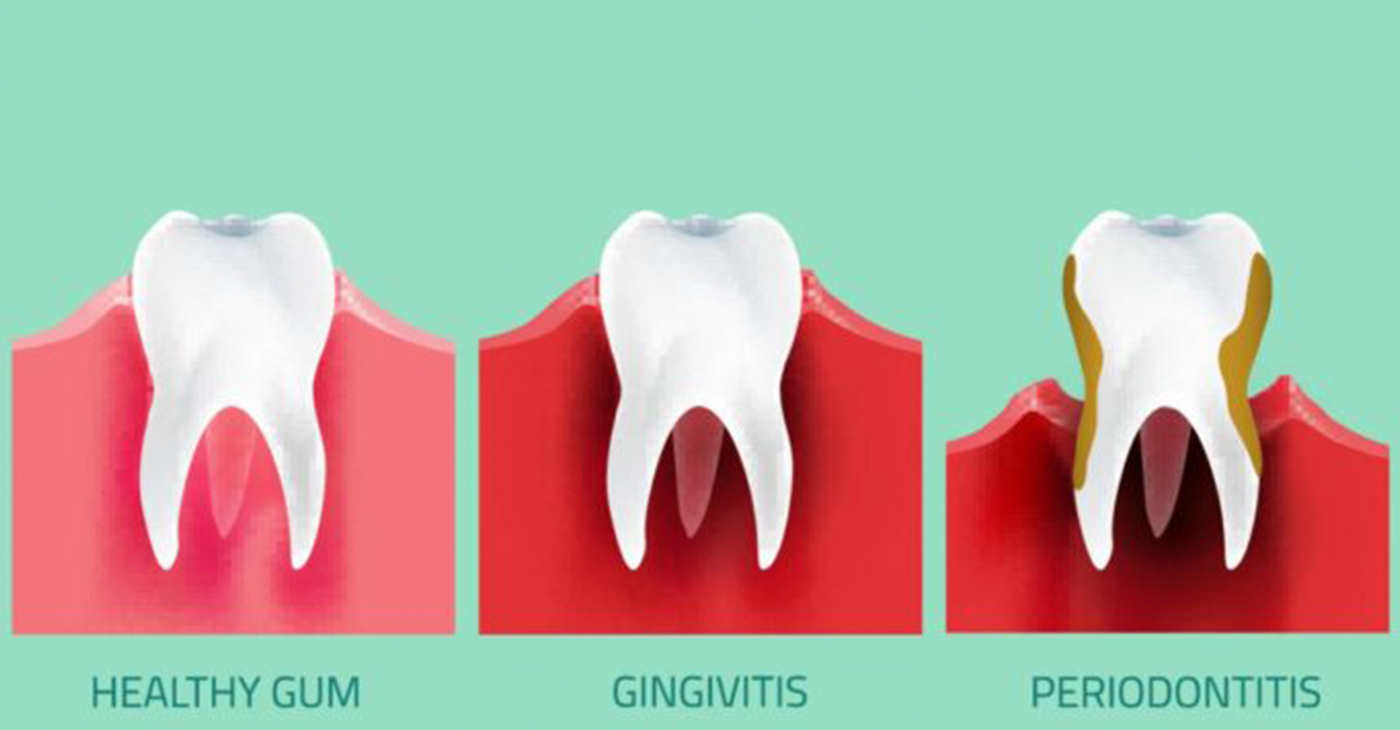 Teeth infographic. Gum disease stages. Editable vector illustration in modern style. Medical concept in natural colors on a light green background. Keep your teeth healthy!