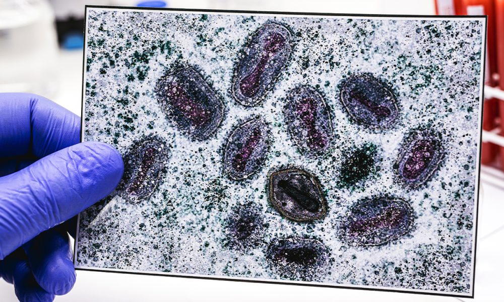 The World Health Organization has already declared monkeypox a global health emergency. New York, the epicenter of the outbreak, Illinois and California have all declared public health emergencies.