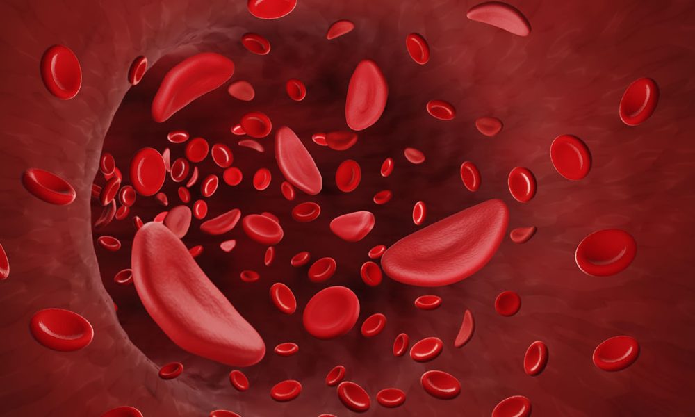Sickle Cell Disease is a rare, genetic blood disorder that primarily affects African American individuals. Sickle Cell Disease is inherited when a child receives two sickle cell genes—one from each parent. A person with Sickle Cell Disease is born with it.