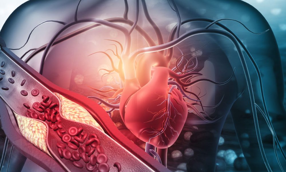Human heart with blocked arteries. 3d illustration (Photo by Rasi Bhadramani)