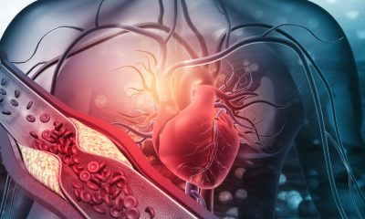 Human heart with blocked arteries. 3d illustration (Photo by Rasi Bhadramani)