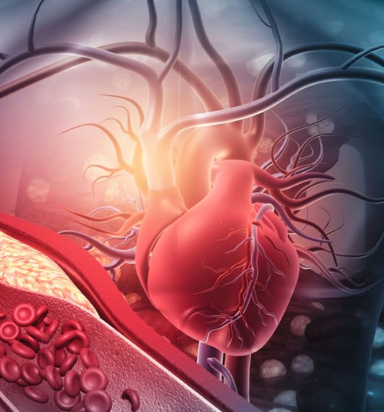 Human heart with blocked arteries. 3d illustration (Photo by Rasi Bhadramani)