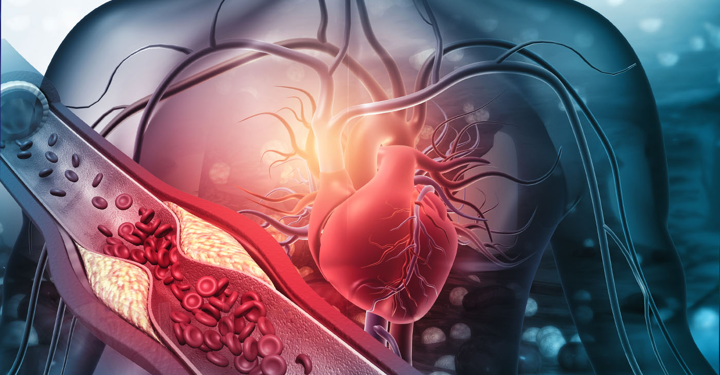 Human heart with blocked arteries. 3d illustration (Photo by Rasi Bhadramani)