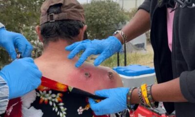 By the time a street medicine team met Alfred Flores last June along the Los Angeles River , two spider bites on his back had swollen with infection, untreated for three days.
