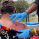 By the time a street medicine team met Alfred Flores last June along the Los Angeles River , two spider bites on his back had swollen with infection, untreated for three days.