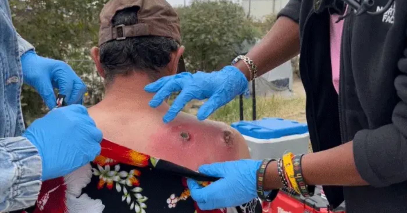 By the time a street medicine team met Alfred Flores last June along the Los Angeles River , two spider bites on his back had swollen with infection, untreated for three days.