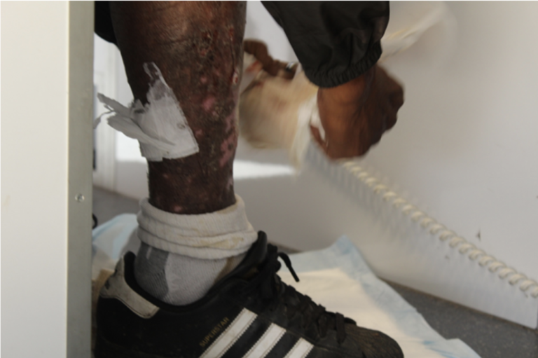 Gilbert Ramirez’s legs during wound cleaning and treatment at the Los Angeles Inn in Inglewood. Photo by Marion Apio